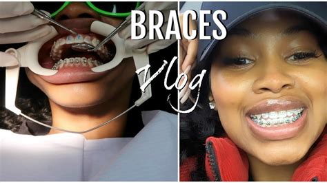 Expanding Your Smile, Expanding Your Horizons: How Braces Can Improve Your Dental Health